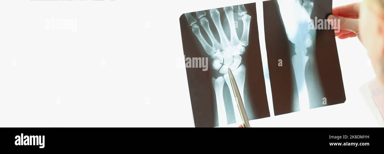Medical worker examine patient hand x ray result on light Stock Photo ...