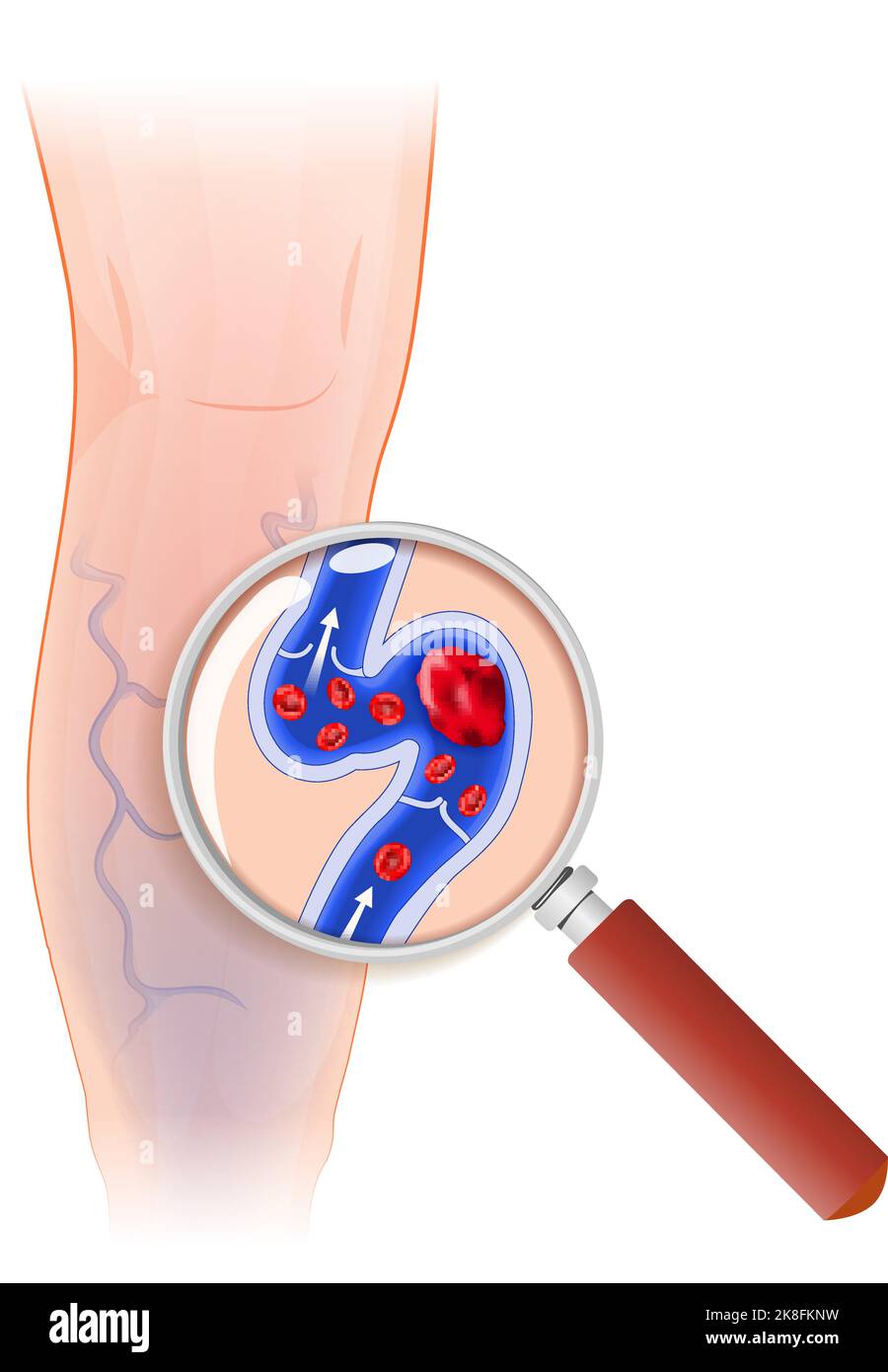 Human's leg affected by varicose veins. blue blood vessel visible through the skin. Cross section of varicose vein through a magnifying glass Stock Vector