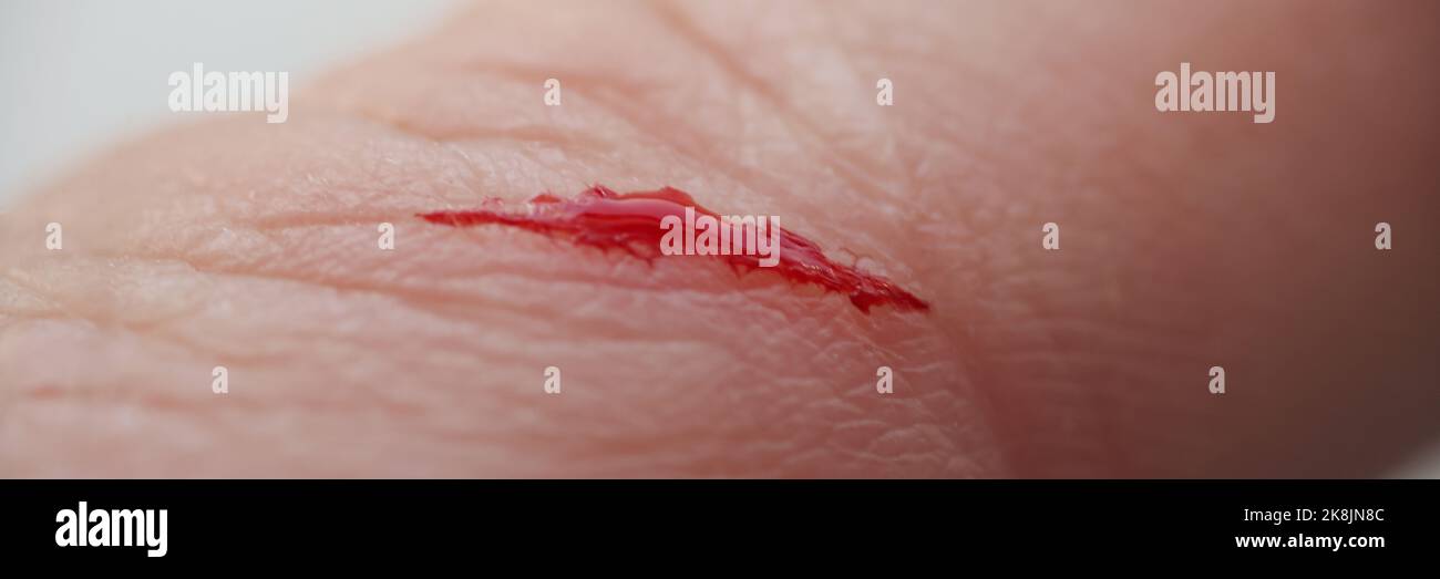 Man with injured finger, bleeding blood on open cut wound Stock Photo