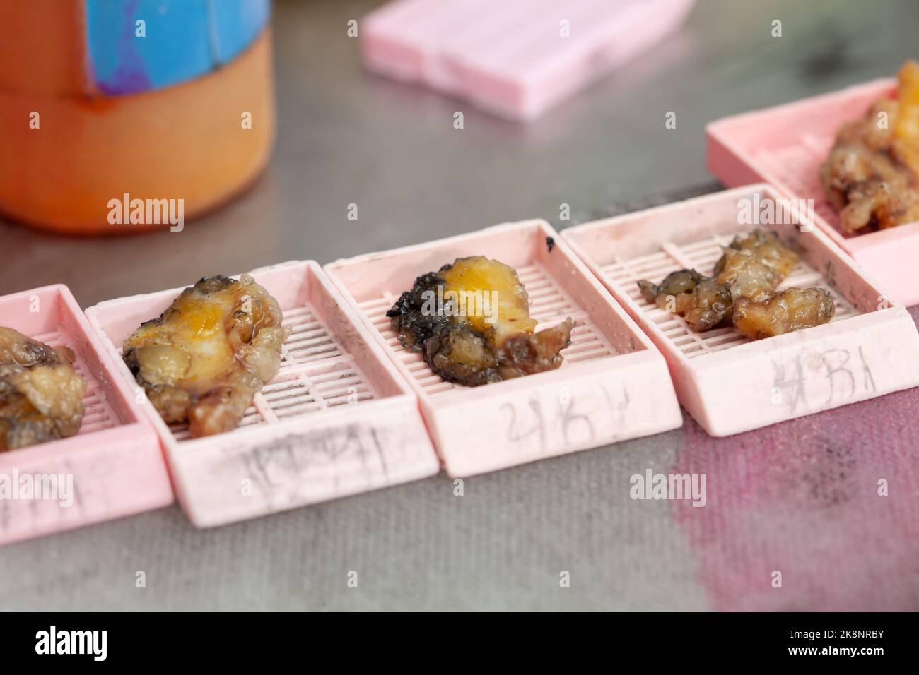 Biopsy samples being processed at the pathology laboratory to be ...