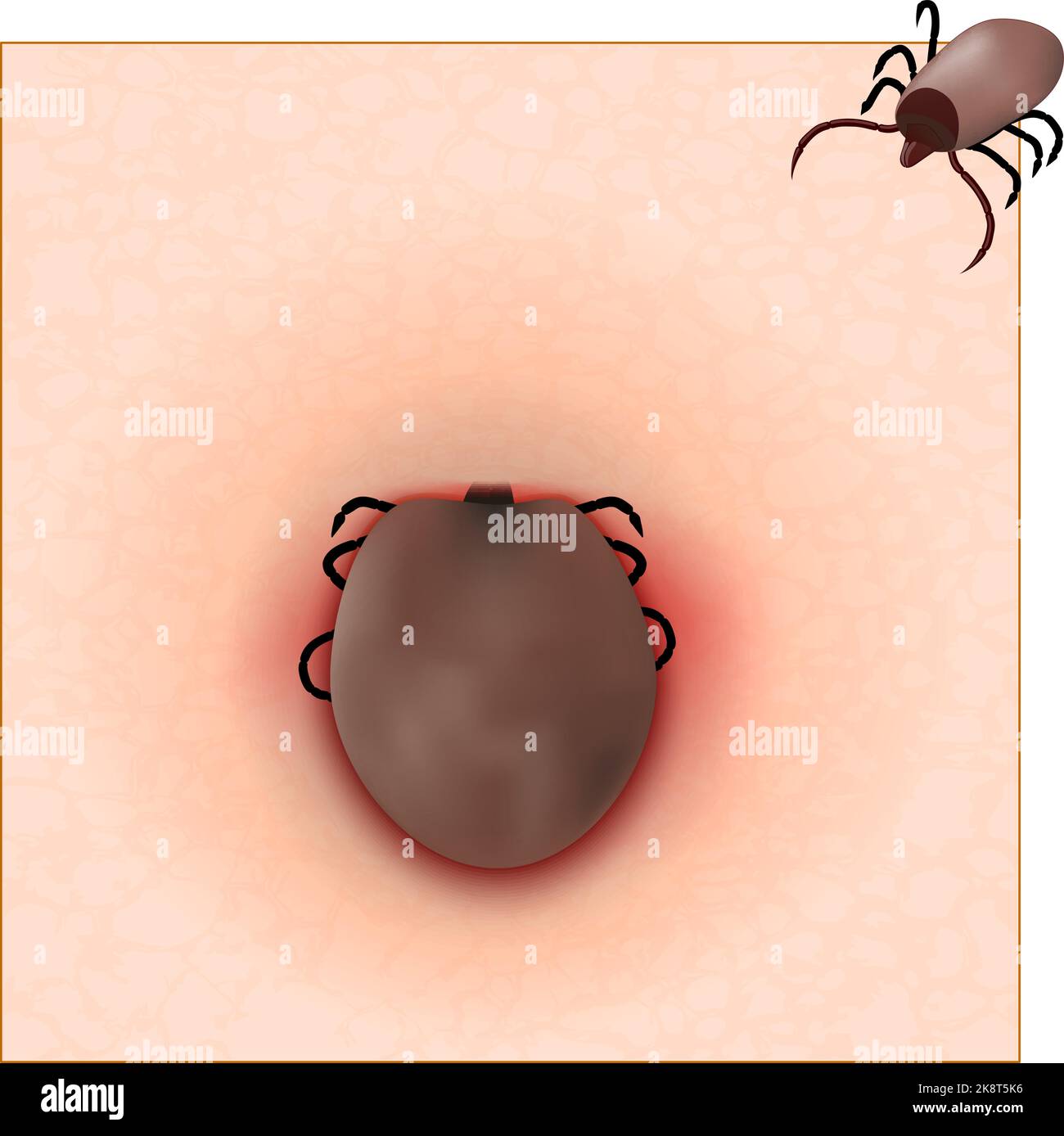 Tick before and after feeding. Tick-borne encephalitis TBE. Mite insect parasites. dangerous insect. Ixodes ricinus on the skin. Vector poster. Stock Vector