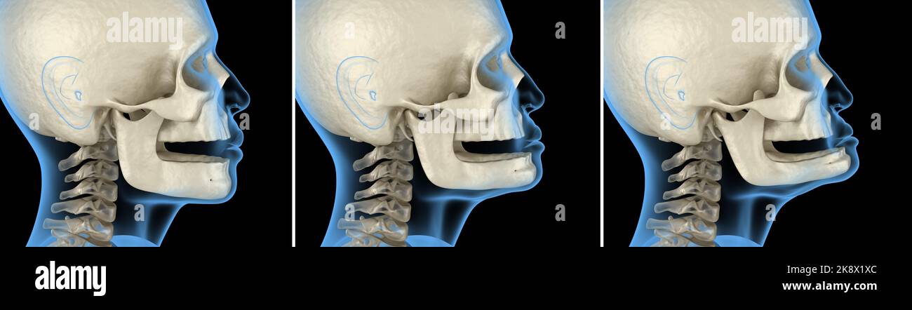 Bone Recession Mandibular Jaw, bone recession after losing teeth. Medically accurate ...