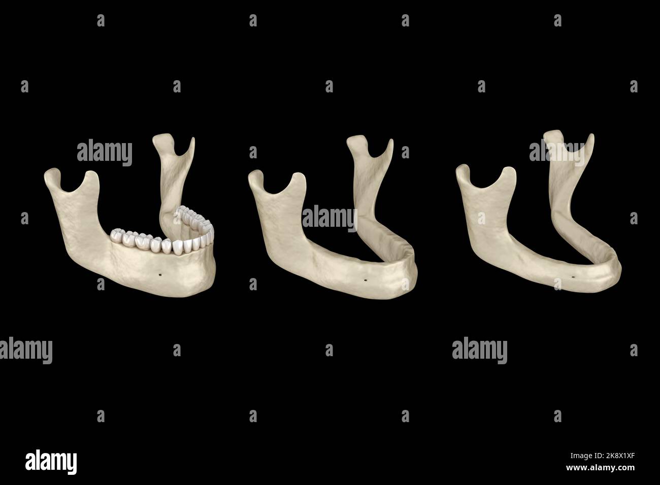 Mandibular Jaw, bone recession after losing teeth. Medically accurate