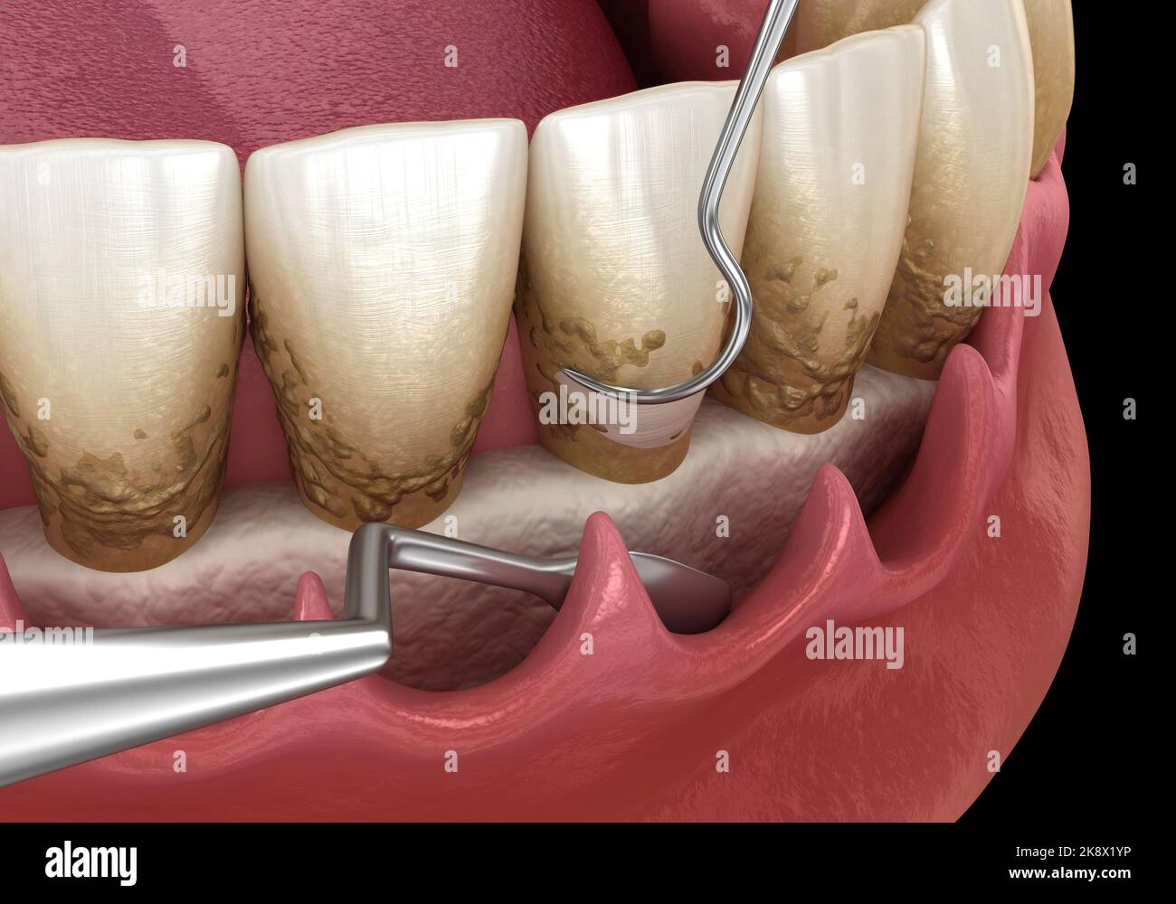 Open curettage Scaling and root planing (conventional periodontal