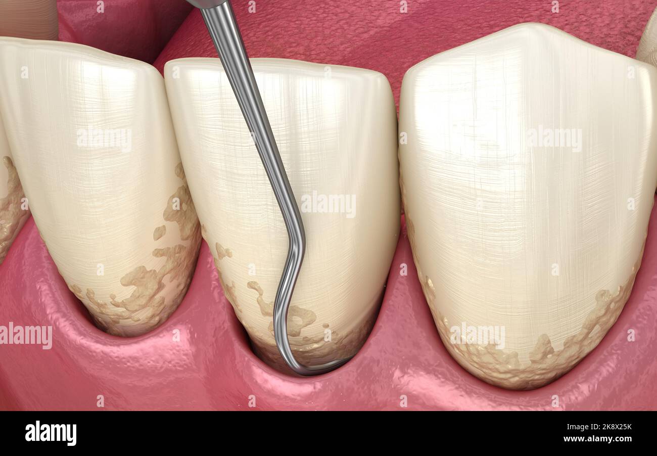 Closed curettage Scaling and root planing (conventional periodontal