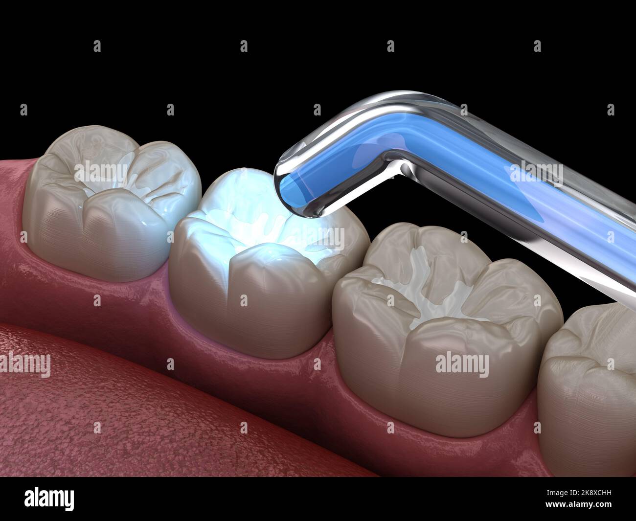 Tooth restoration with filling and polymerization lamp. Medically