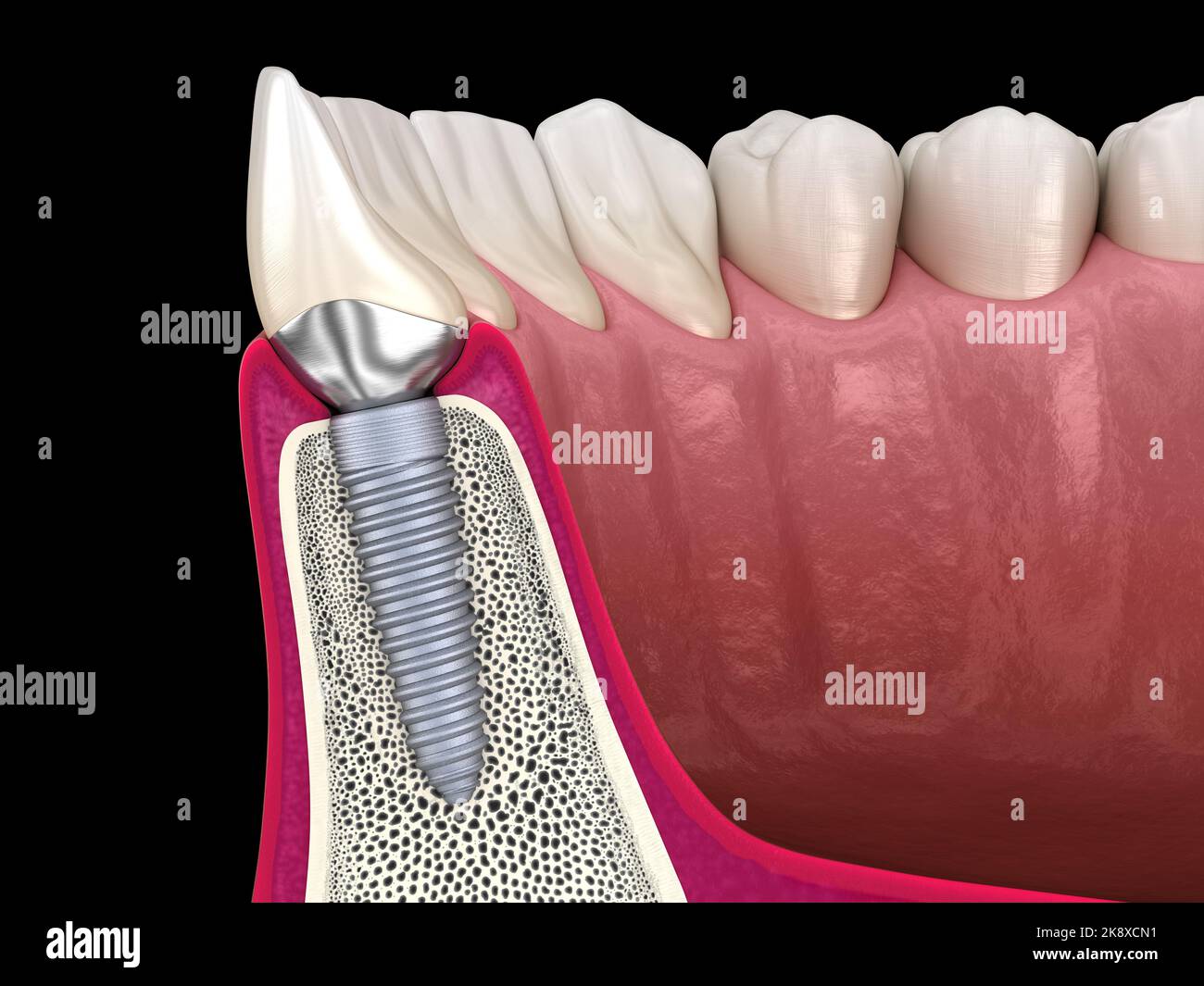 Custom abutment, dental implant and ceramic crown. Medically accurate