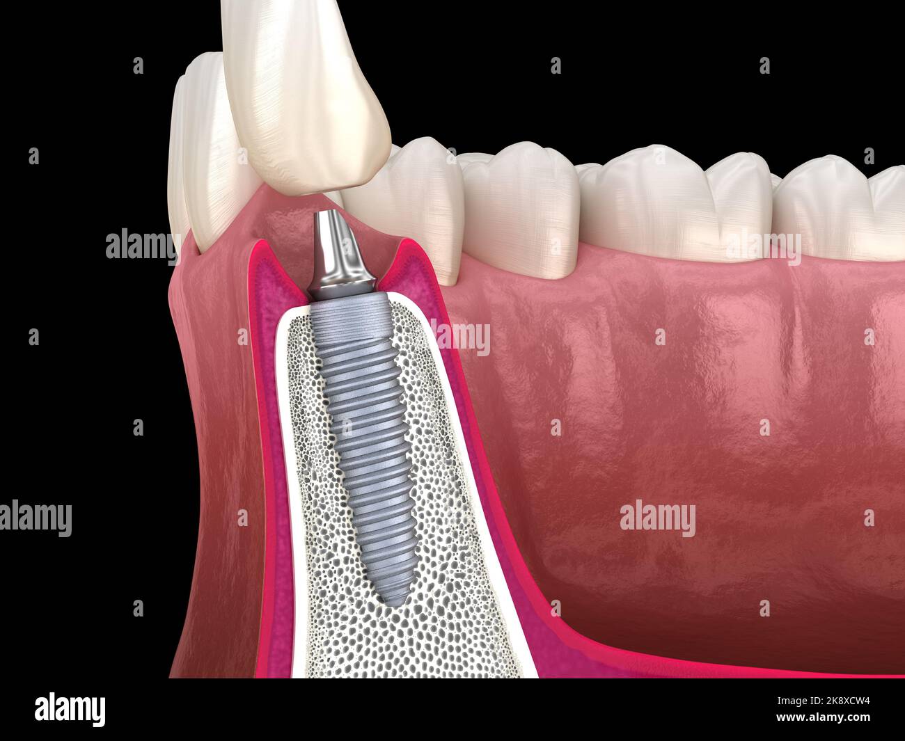 Standard abutment, dental implant and ceramic crown. Medically accurate