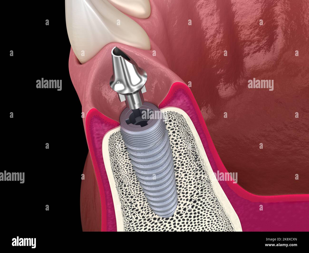 Standard abutment, dental implant and ceramic crown. Medically accurate