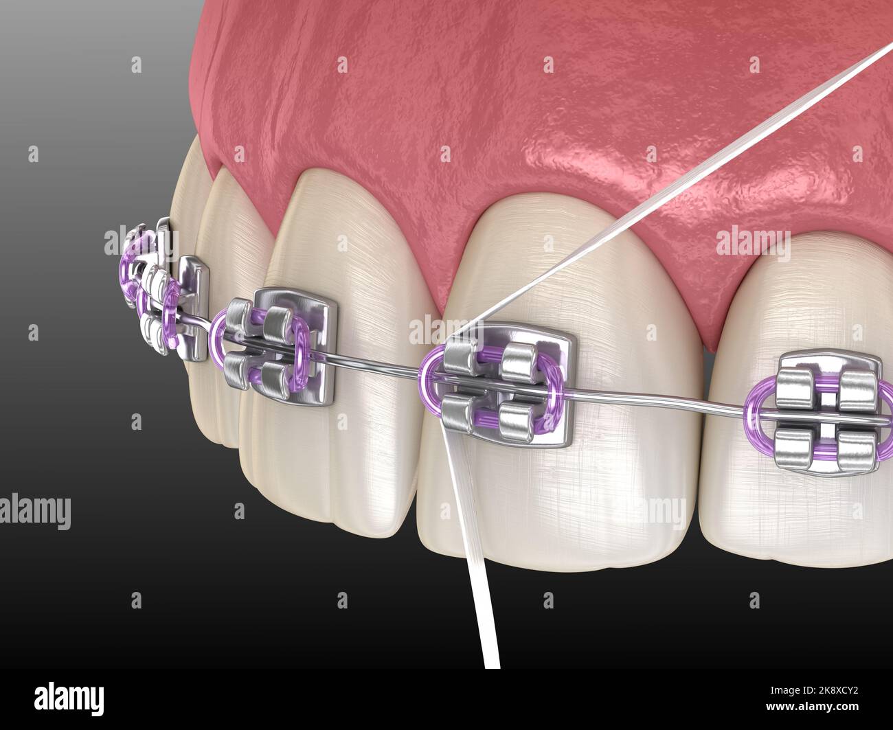 Dental floss cleaning braces process. Medically accurate 3D
