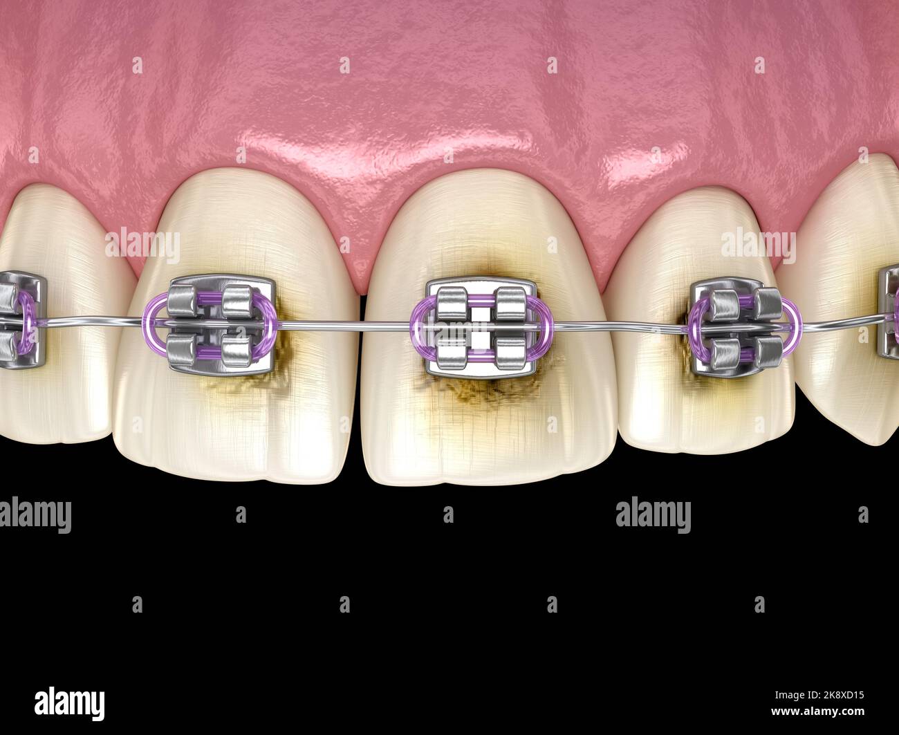 Caries process near braces as result by poor hygiene. Medically