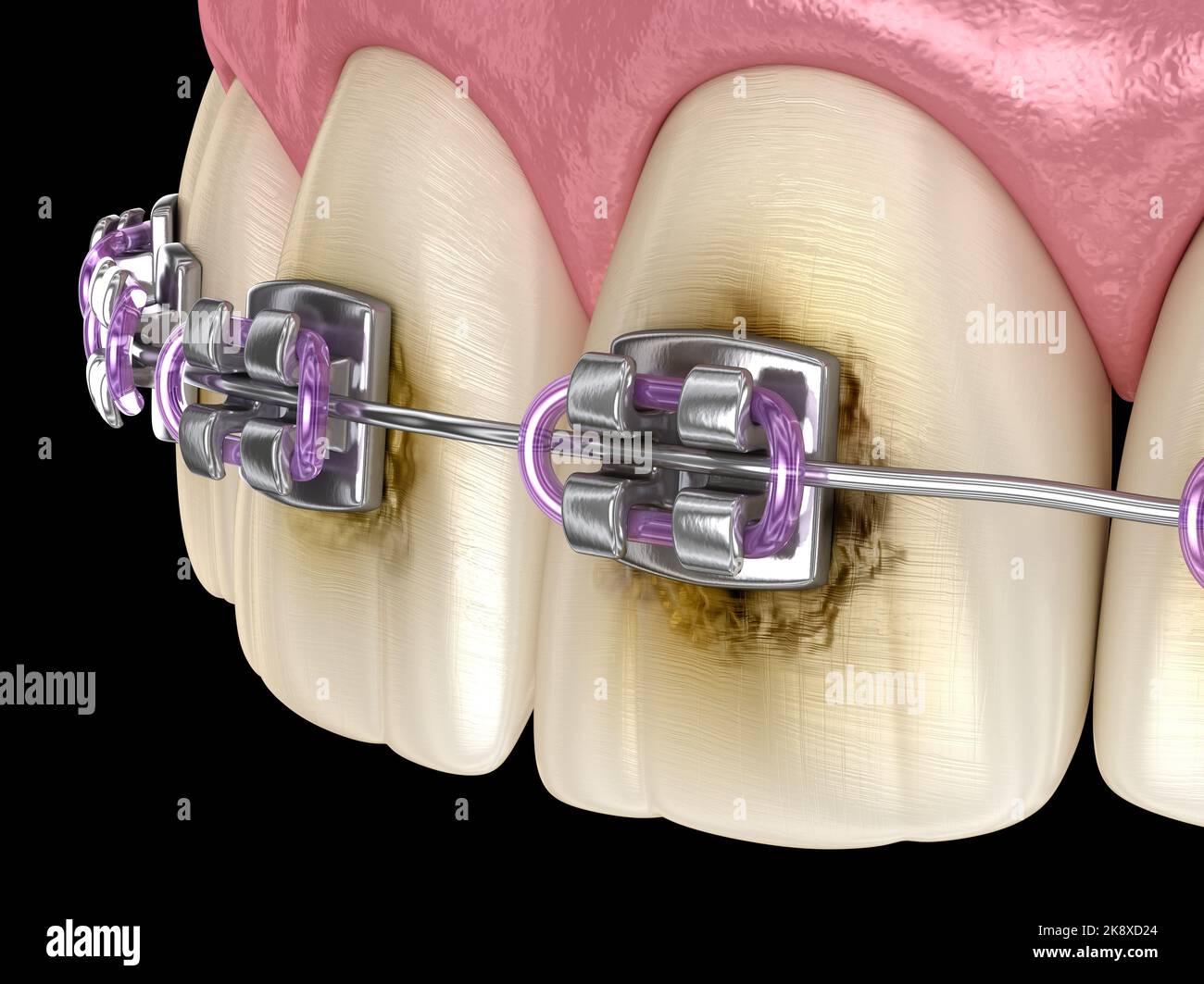 Caries process near braces as result by poor hygiene. Medically ...