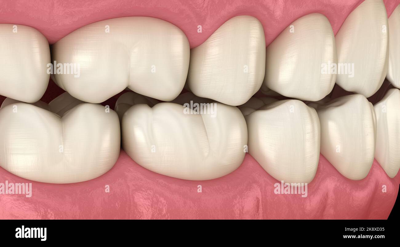 Traumatic Occlusion. Medically accurate 3D illustration Stock Photo - Alamy
