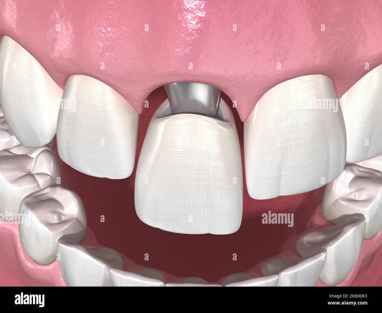 Custom abutment, dental implant and ceramic crown. Medically accurate