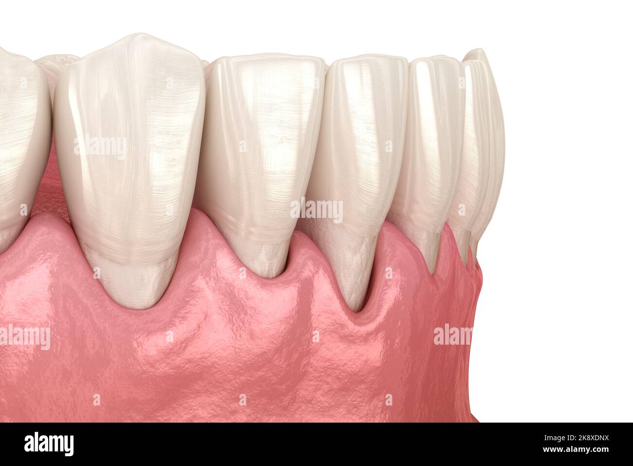 Gum recession process. Medically accurate 3D illustration Stock Photo