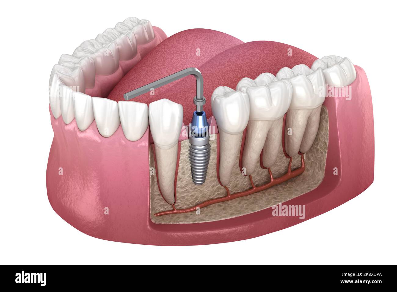 Implant abutment fixation procedure. Medically accurate 3D illustration