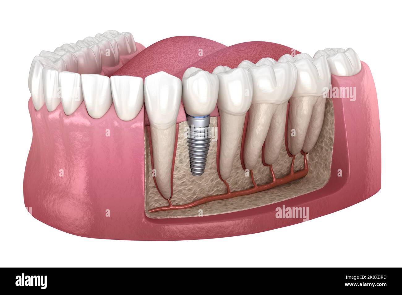 Premolar tooth crown installation over implant abutment. Medically