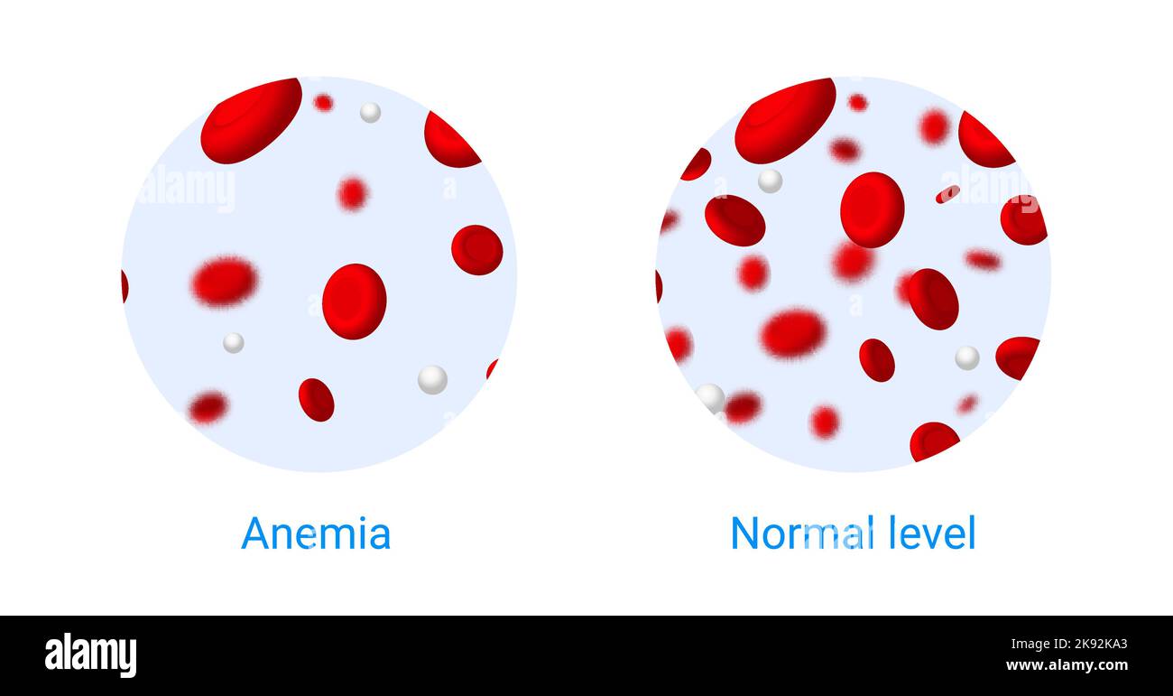 Anemia problem circulatory iron body diagram background. Anaemia biology blood isolated medical normal icon. Stock Vector