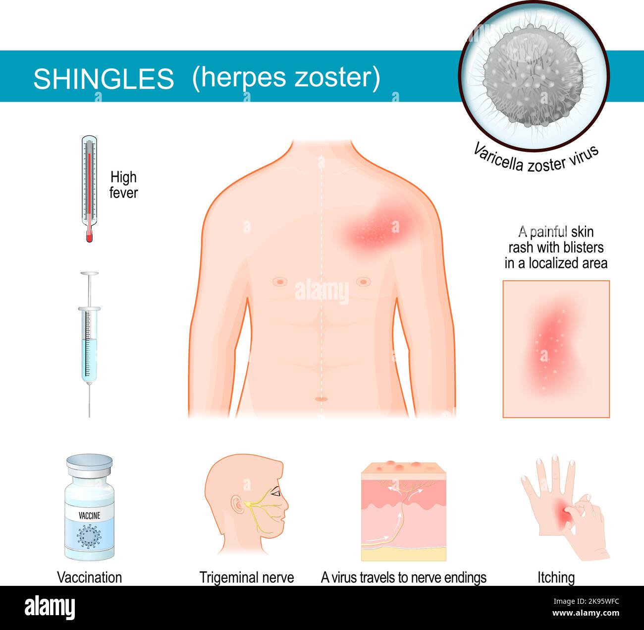 Shingles. infographics about Signs and symptoms of herpes zoster. Human torso with itching rash. Close-up of Varicella zoster virus. Stock Vector