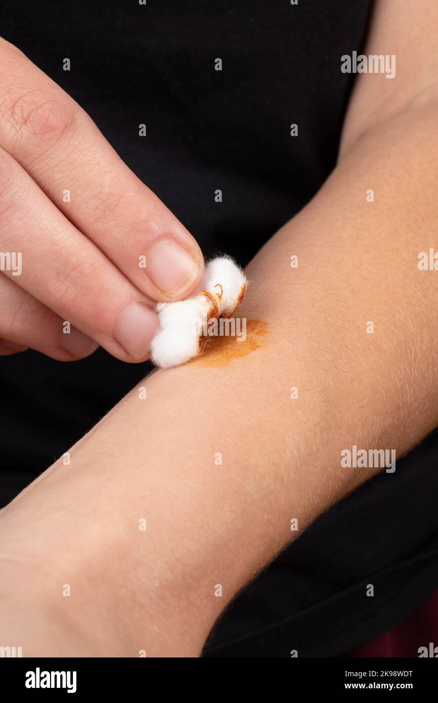 decontamination of a snake bite wound with iodine solution, medical treatment hand from poison. Stock Photo