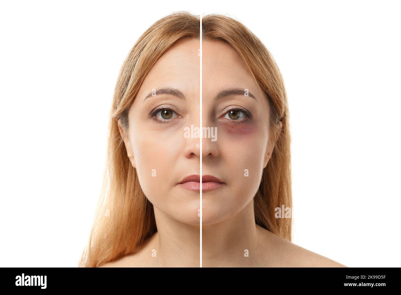 Face of mature woman with and without bruise under eye on white background Stock Photo