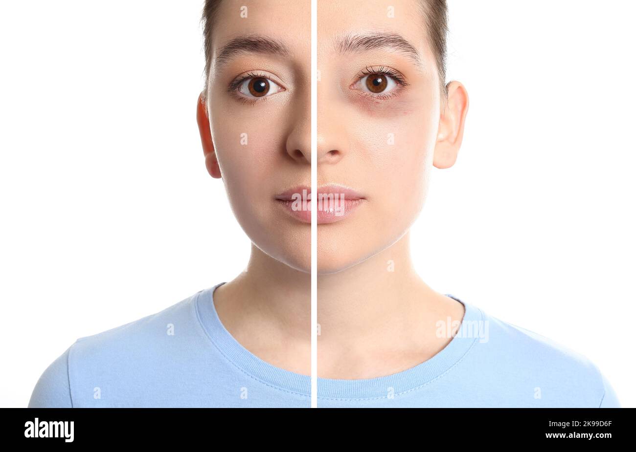 Face of young woman with and without bruise under eye on white