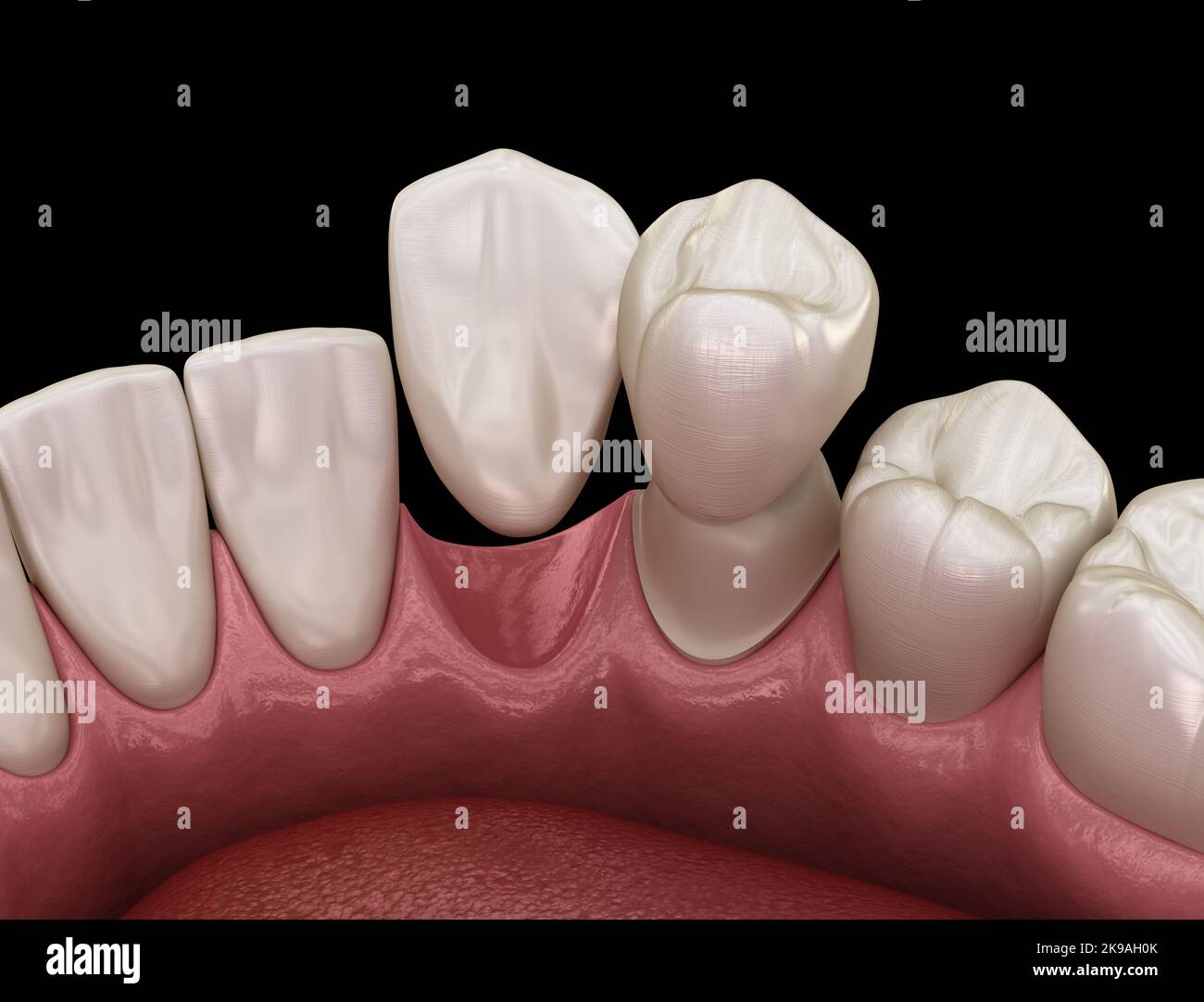 Cantilever bridge made from ceramic, frontal tooth recovery. Medically accurate 3D animation of