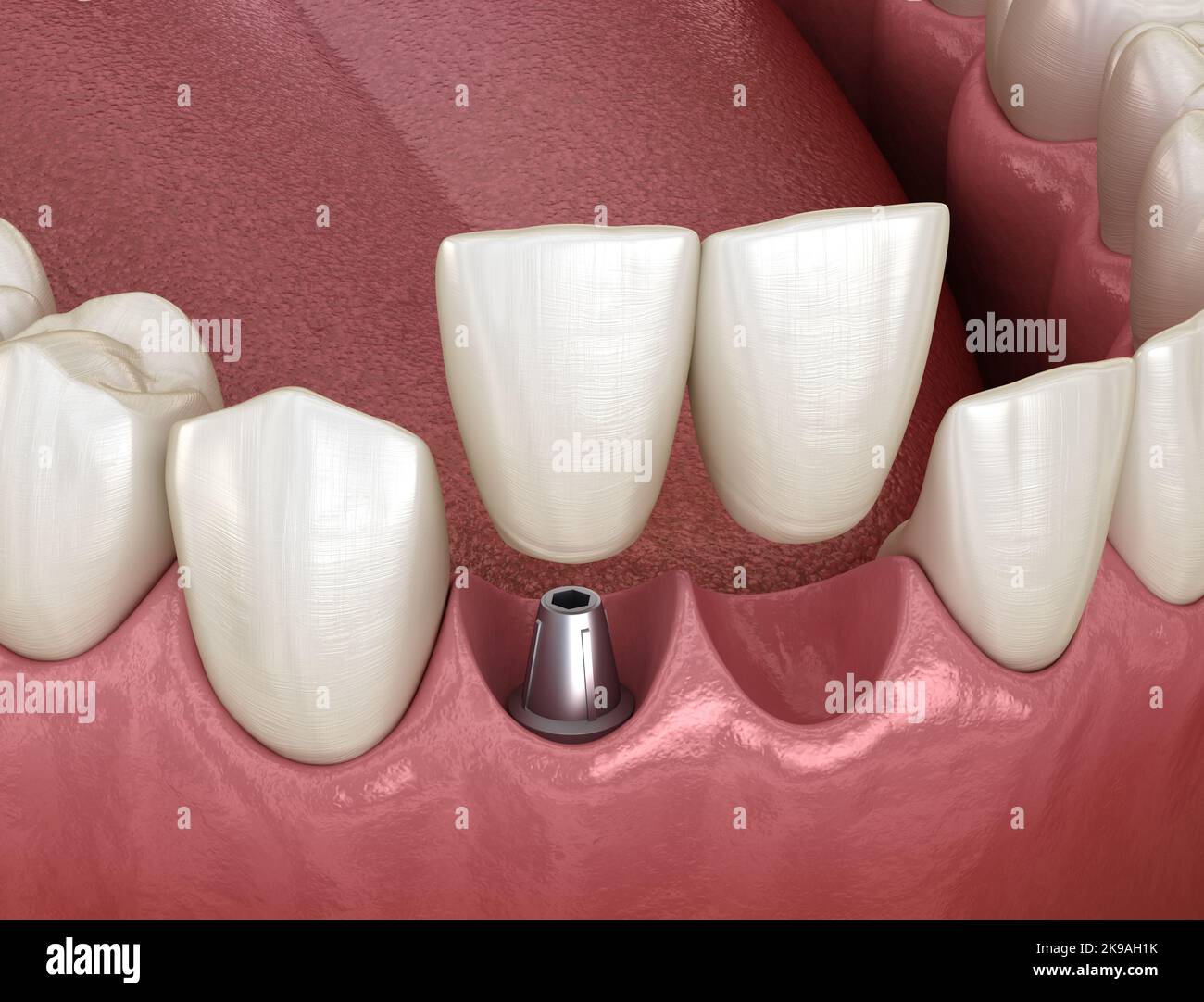 Cantilever bridge implant based, frontal tooth recovery. Medically