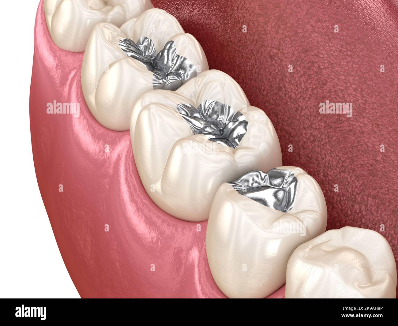 Amalgam restoration. Medically accurate 3D animation of dental concept