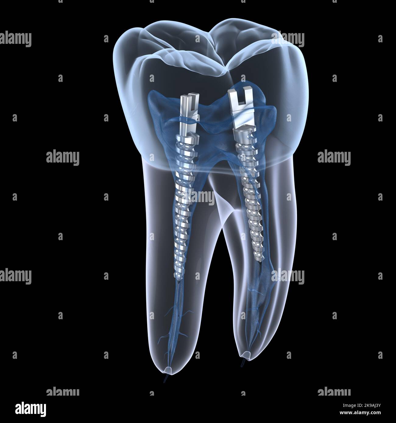 Dental steel post inside molar teeth, Xray view. Dental endodontic