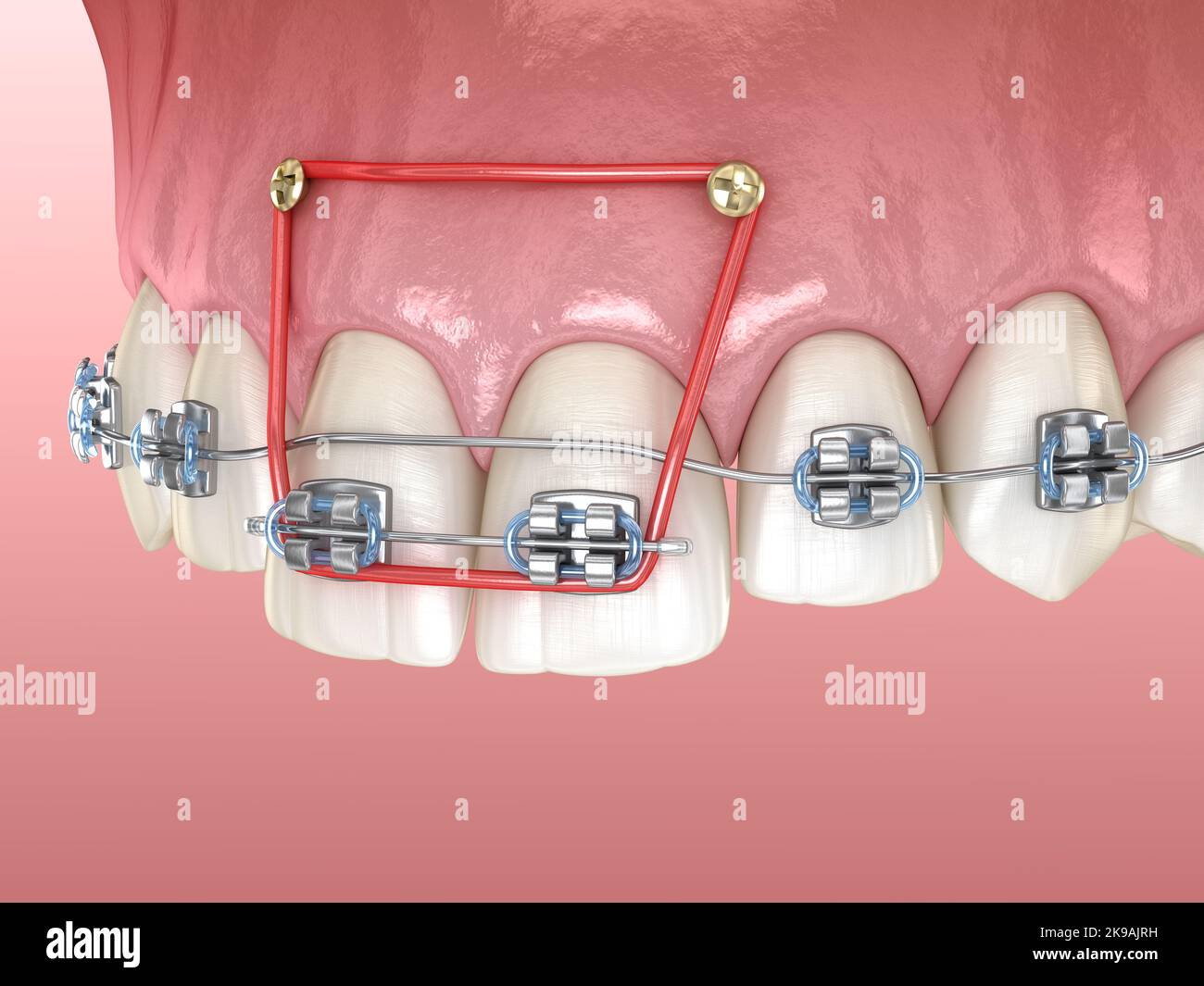 Elastics and metal braces for correction overbite of frontal incisors