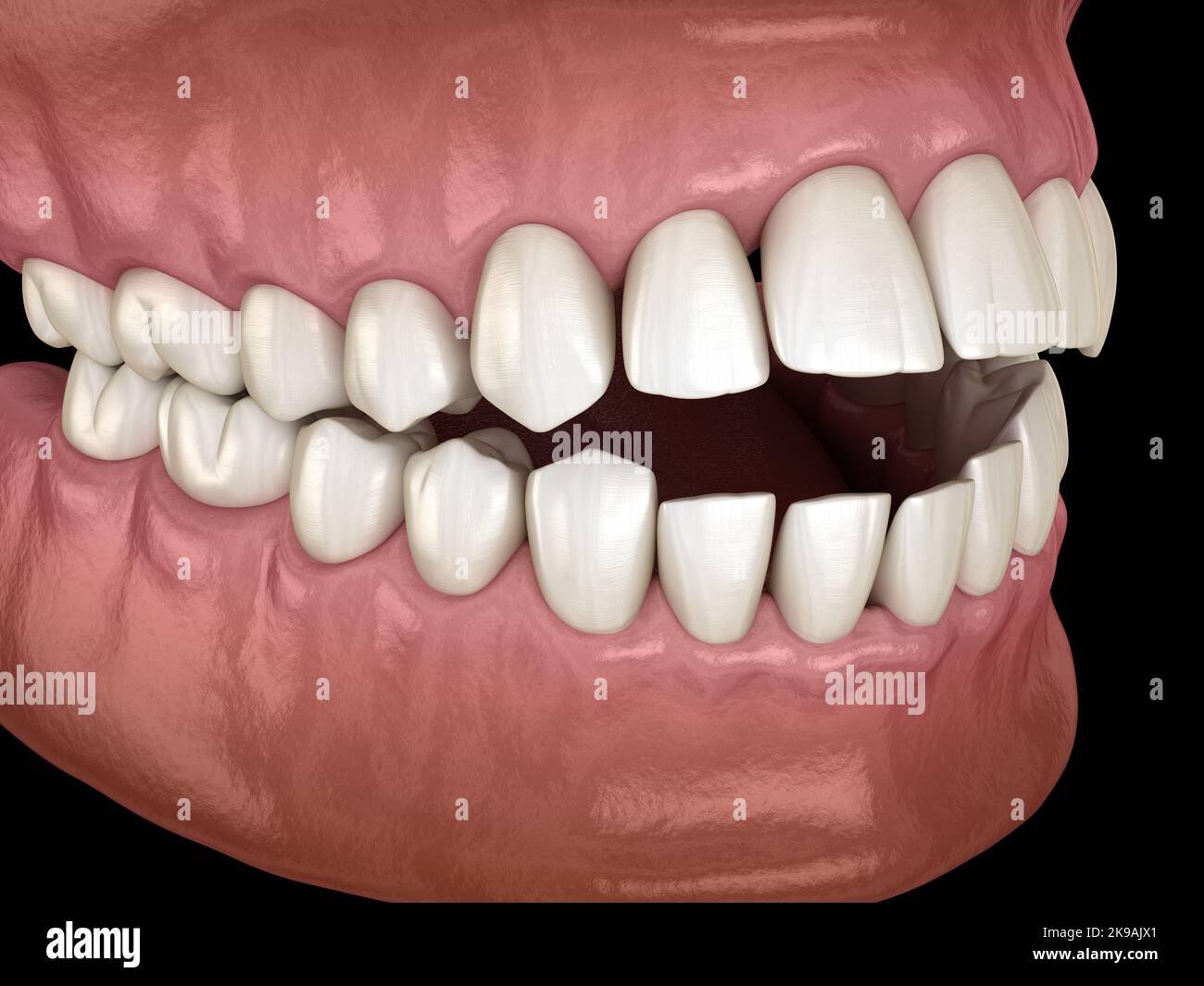 Openbite dental occlusion ( Malocclusion of teeth ). Medically accurate ...