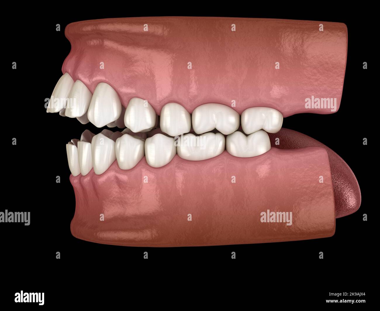 Openbite dental occlusion ( Malocclusion of teeth ). Medically accurate ...