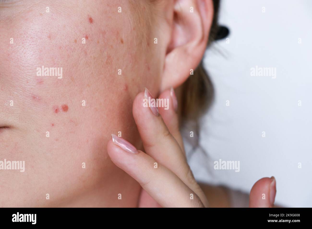 close up natural woman bad acne skin with scars  Stock Photo