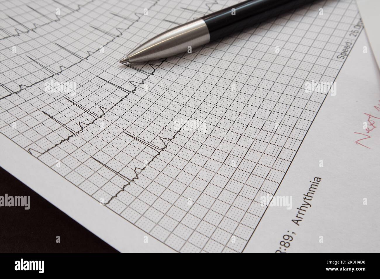 Electrocardiogram (ECG or EKG) presenting possible arrhythmia. Stock Photo