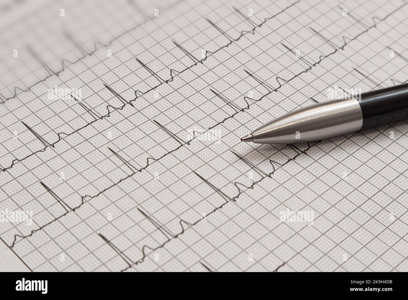 Electrocardiogram presenting possible arrhythmia. Stock Photo