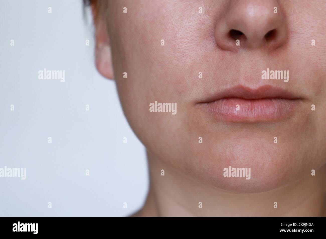 close up natural woman bad acne skin with scars  Stock Photo