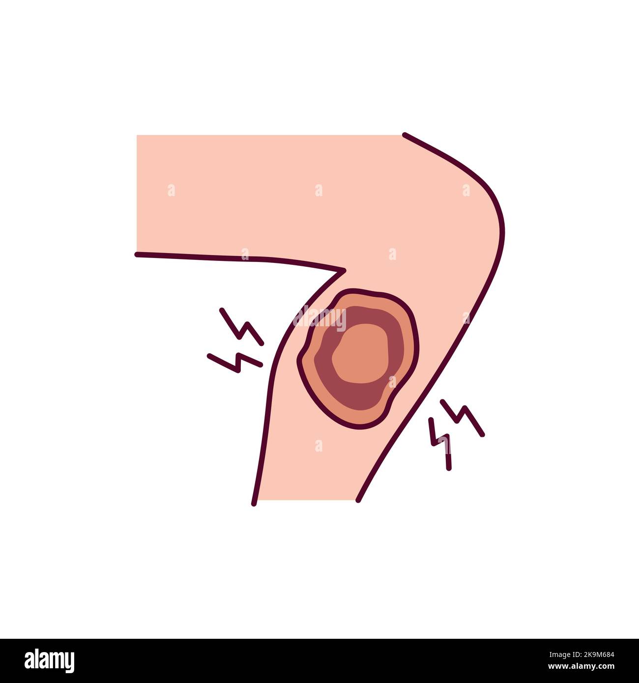 Capillary bleeding hi-res stock photography and images - Alamy