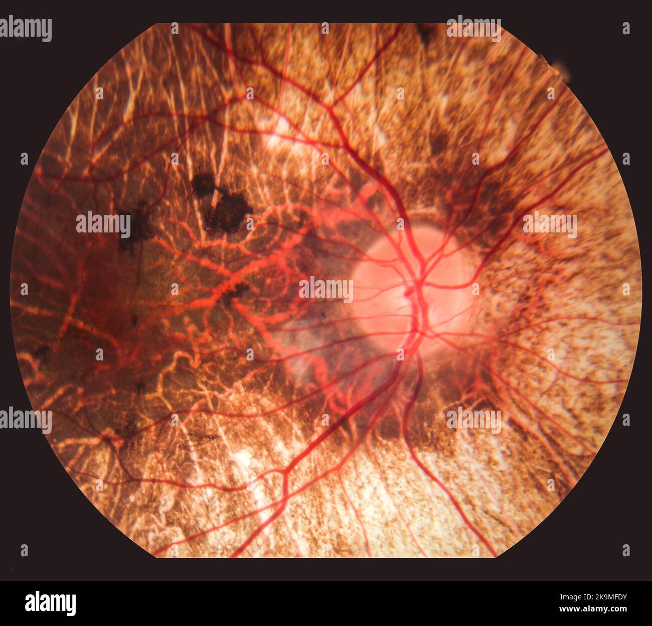 Photography of Human Eye Retina Stock Photo