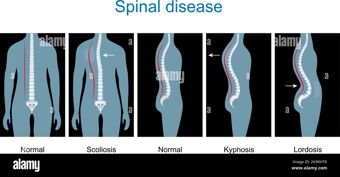 Spinal disease. types of spine defects. Human Skeleton and bones. Vertebral column disorders. Normal spine and Spinal deformity from Scoliosis Stock Vector