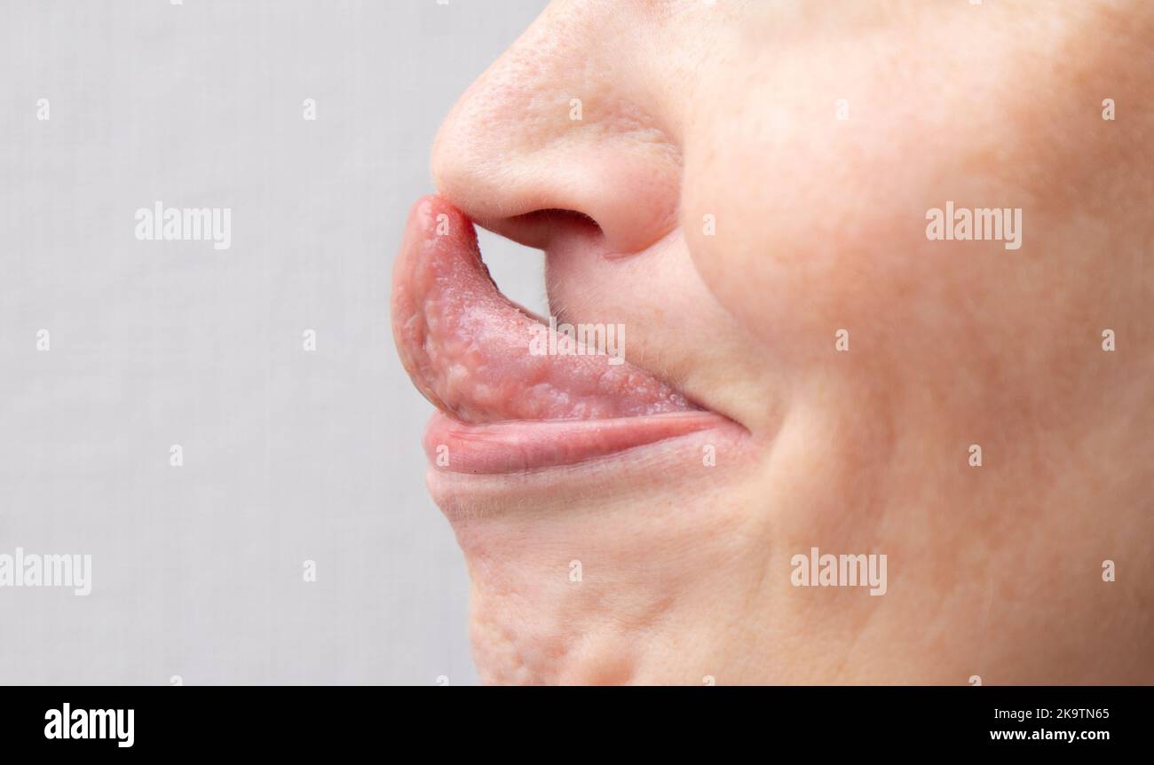 The Gorlin sign is a medical term that indicates the ability to touch the tip of the nose with the tongue. Might be the sign of Ehlers–Danlos syndrome Stock Photo