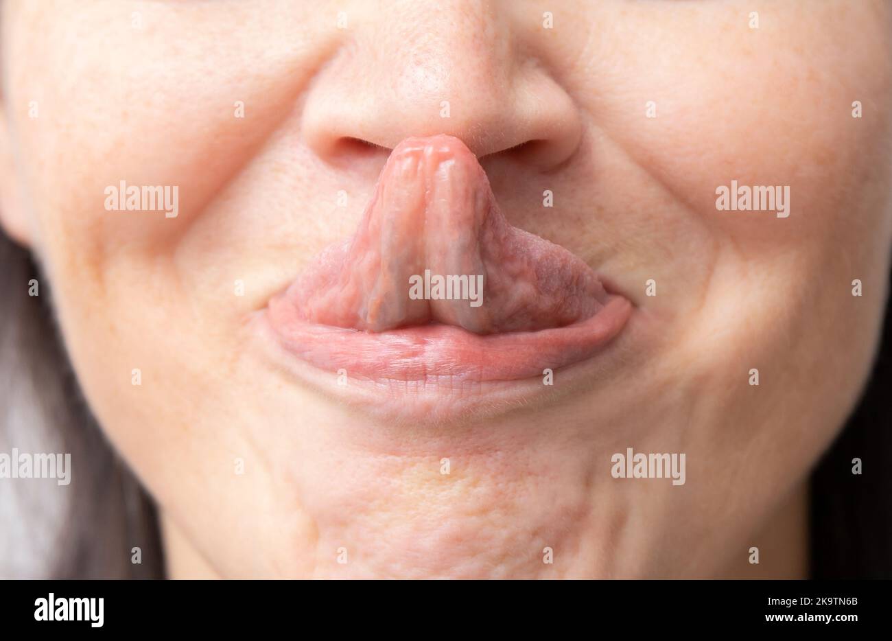 The Gorlin sign is a medical term that indicates the ability to touch the tip of the nose with the tongue. Might be the sign of Ehlers–Danlos syndrome Stock Photo