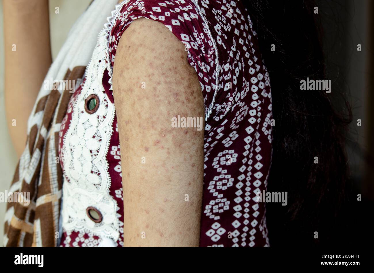 A closeup of a flaky rash on a shoulder and an arm. The concept of ...