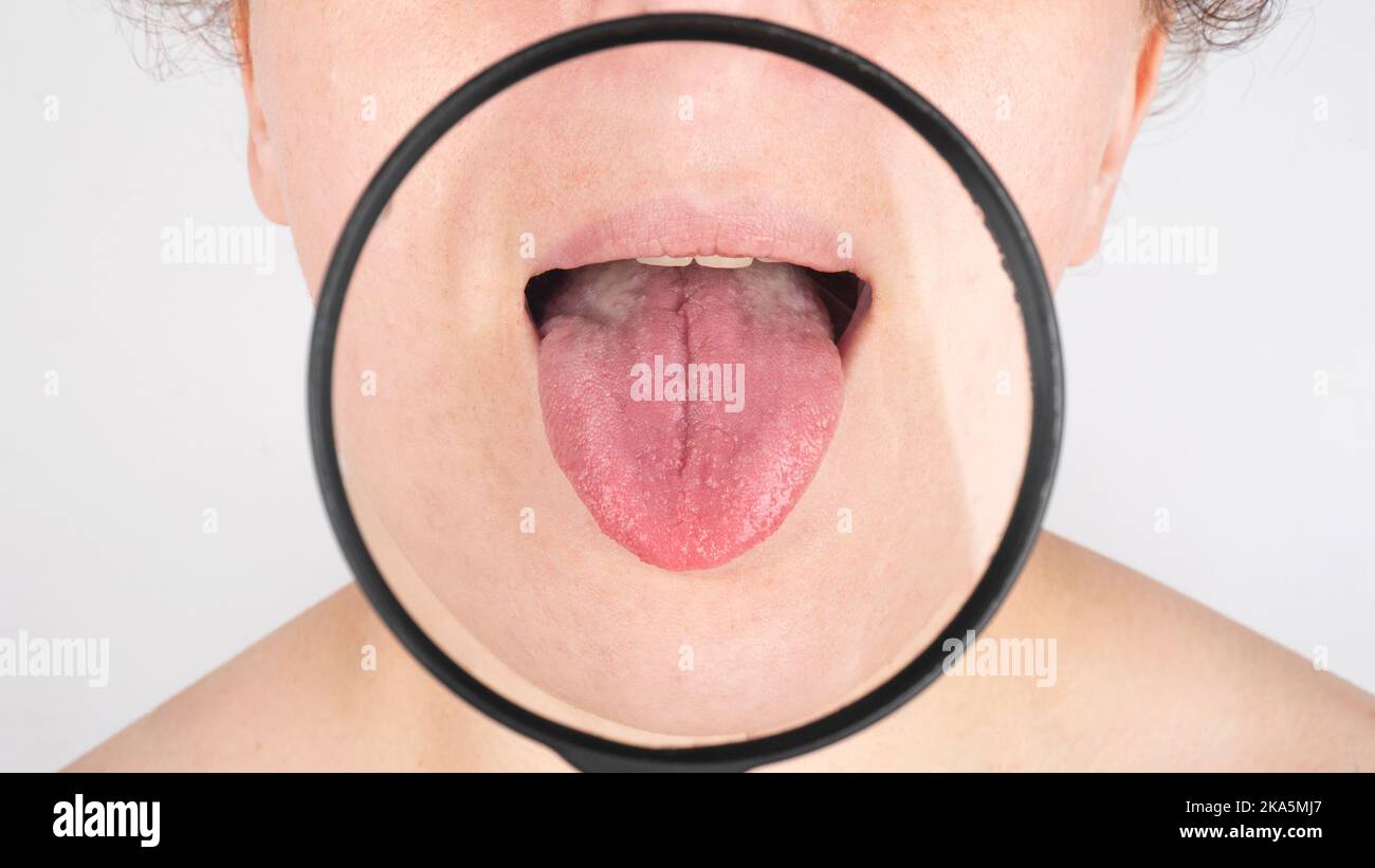 medical examination of the tongue of a patient with a gastritis white coating , tongue cancer. Stock Photo