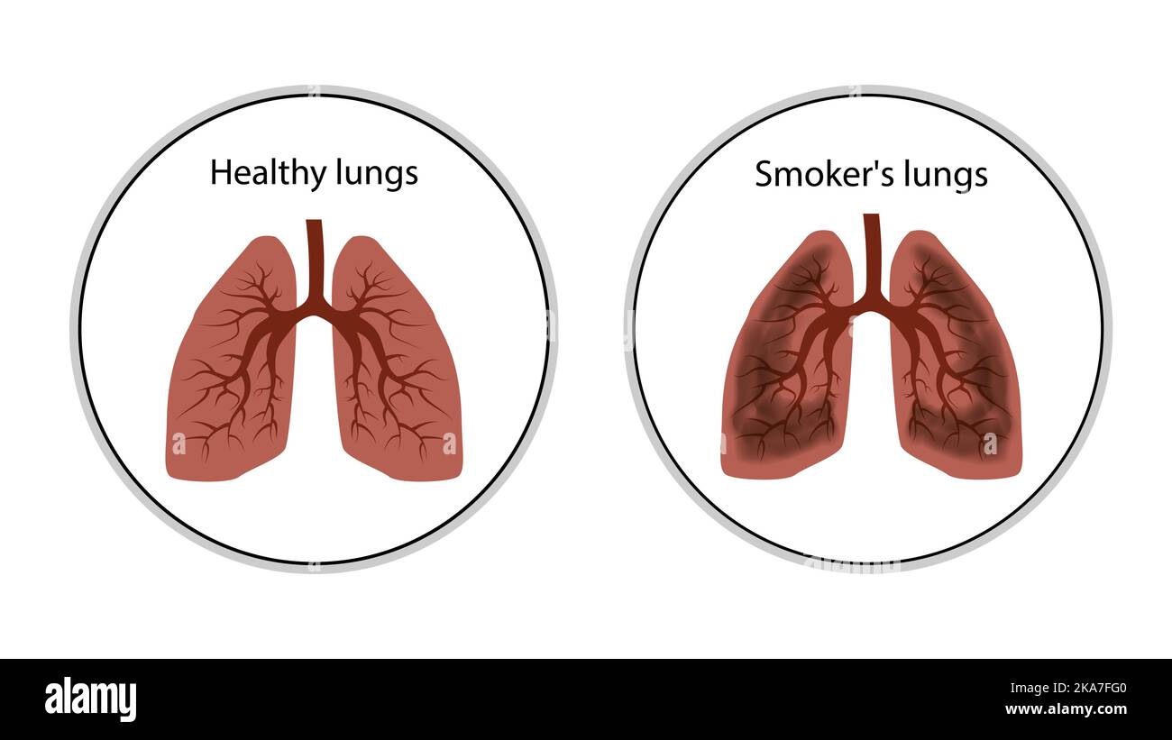 Healthy lungs and smokers lungs icon in circles isolated on white