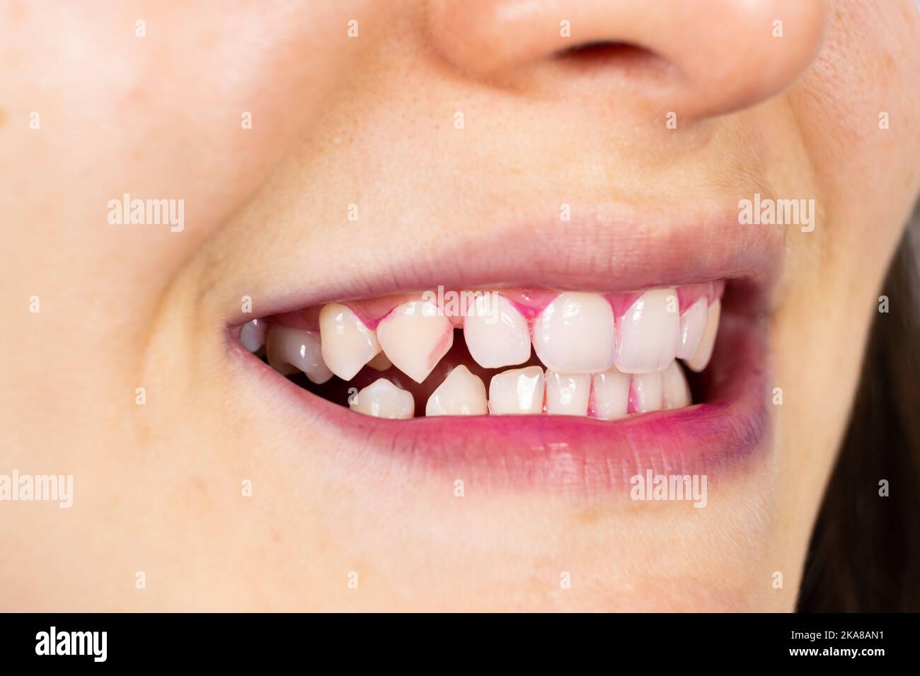 Plaque on human teeth is colored pink with indicator tablets. Stock Photo