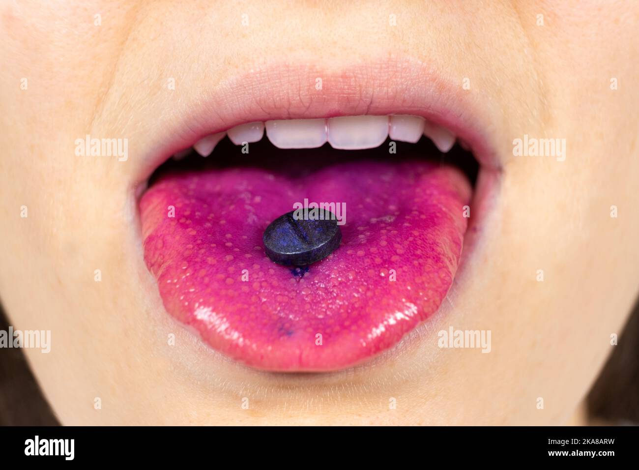 Figure 2 from Formation of mucogingival defects associated with intraoral  and perioral piercing: case reports. | Semantic Scholar
