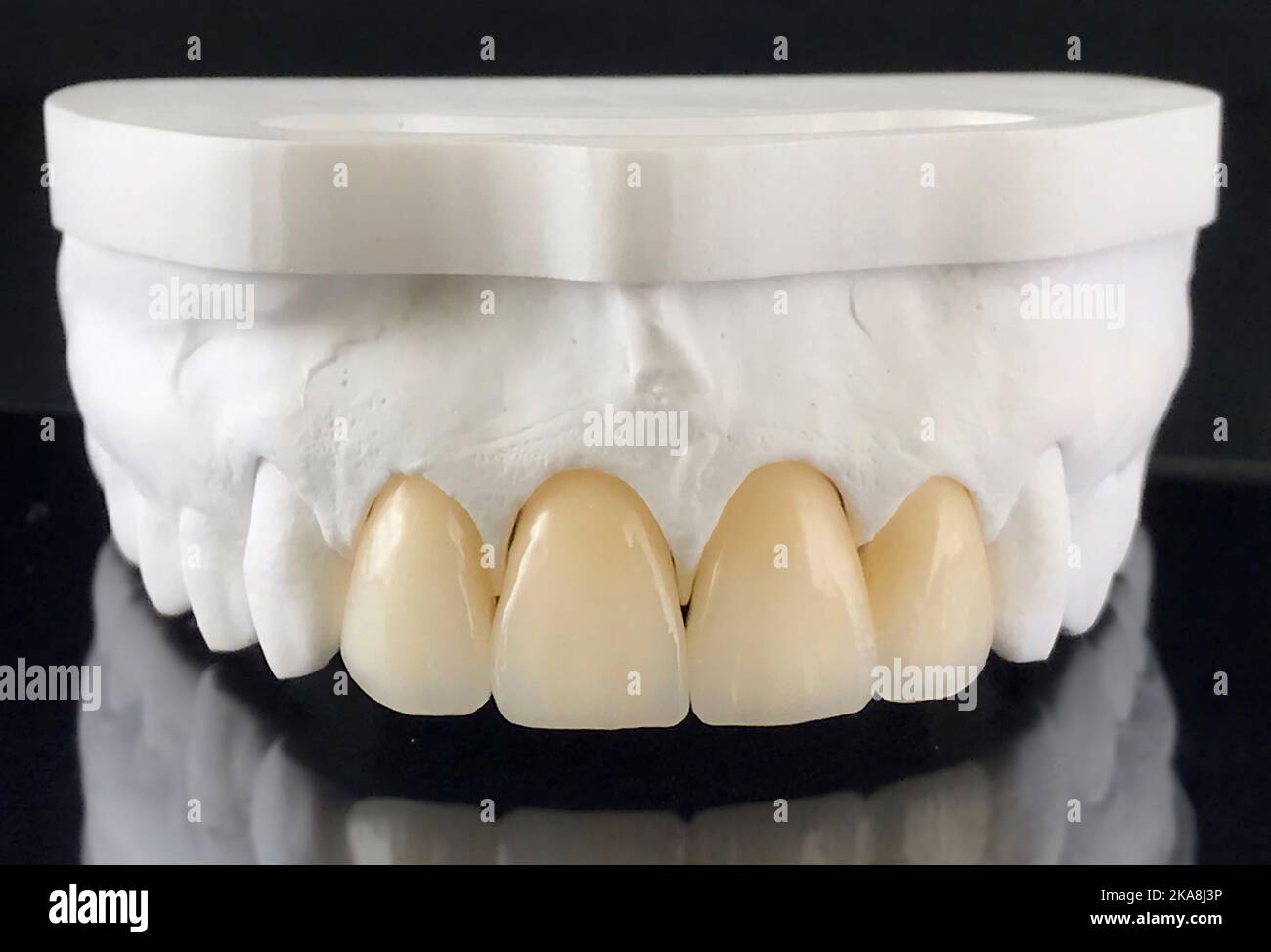 Restoration of teeth on the upper jaw. Production of dental veneers in