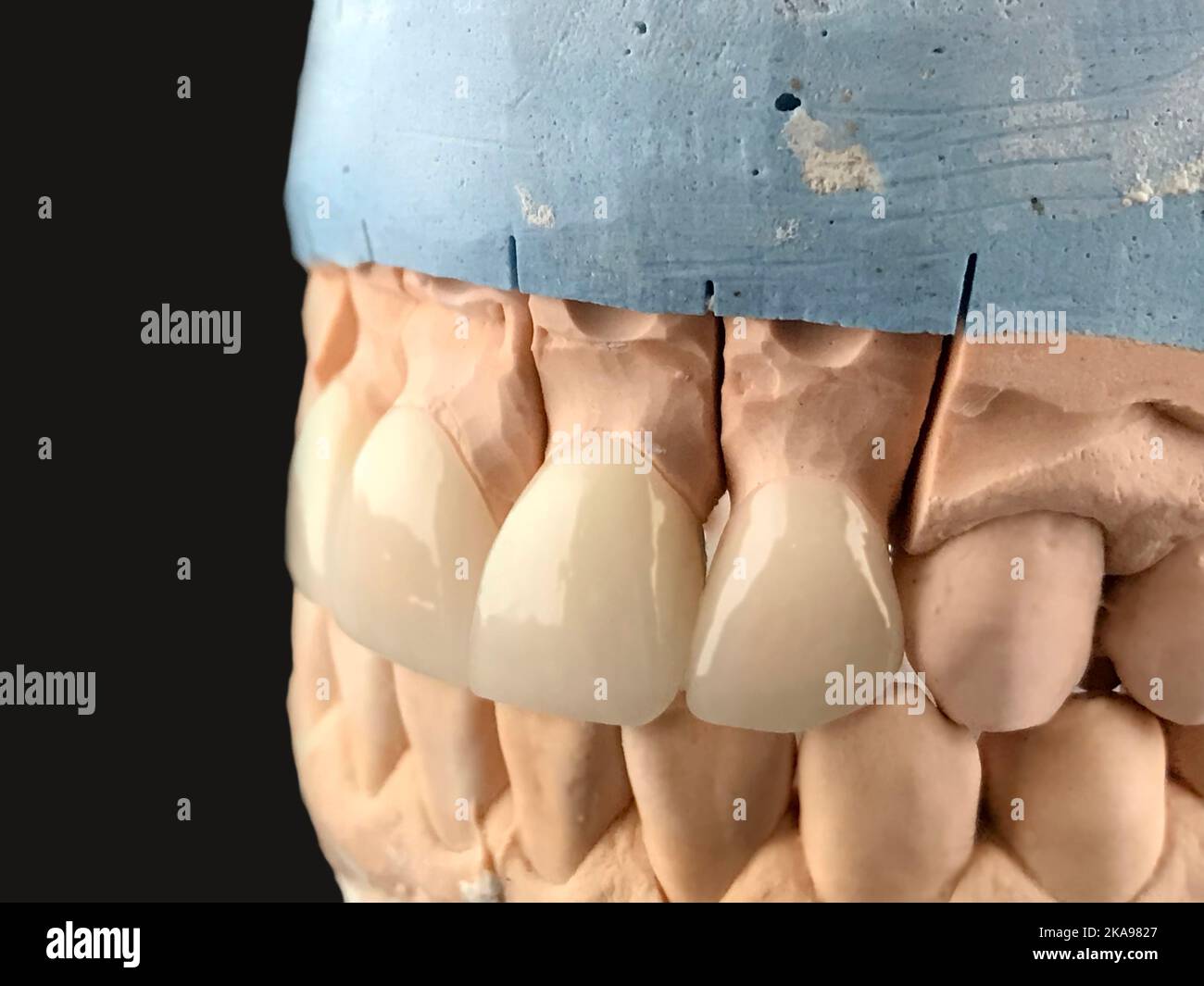 Press ceramic crowns and veneers a 1 color. Restoration of teeth