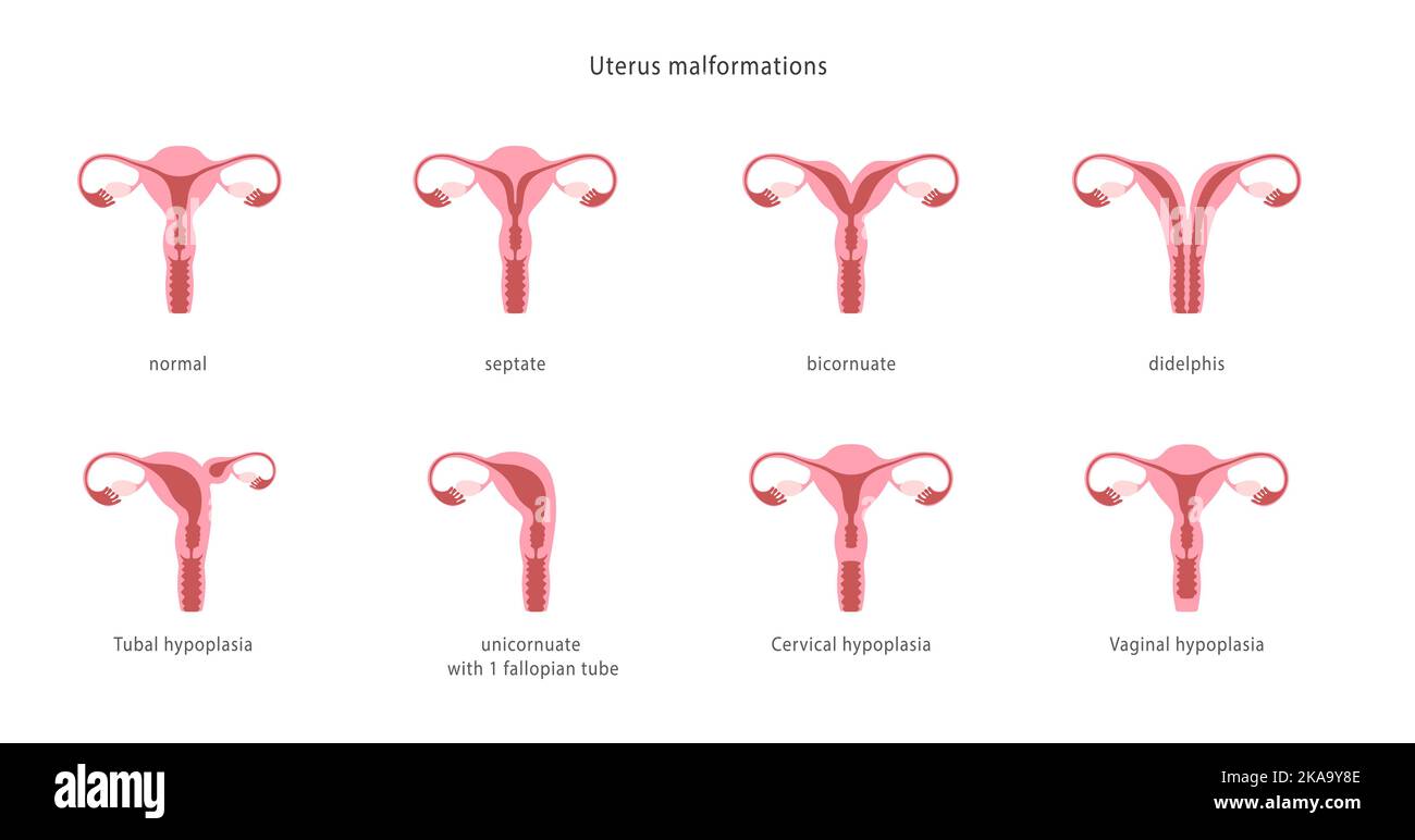 Human uterine malformations. Set of medical charts. Stock Vector